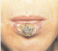 Дальнейшее развитие папиллярного рака губы: переход в стадию Т3
