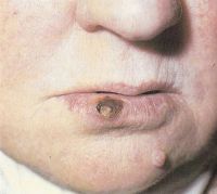 Часть узла при предраке губы на границе с кожей покрыта чешуйками