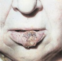 Язвенно-инфильтративная форма рака нижней губы: опухоль в средней трети губы, Т2