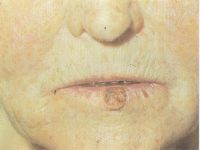 Еще одна больная с папиллярной формой рака губы на стадии Т1
