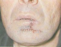 Вид больного после квадратной резекции нижней губы