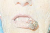 Злокачественное нообразование расположено в боковой трети нижней губы, Т3