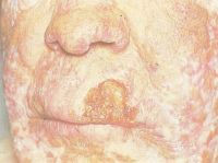 Рак верхней губы на фоне туб. волчанки