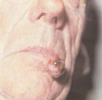 Плотный узел расположенный в области боковой трети красной каймы и кожи нижней губы 