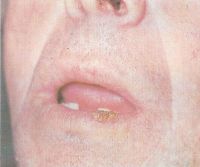 Бородавчатый (узелковый) предрак красной каймы нижней губы (узел полушаровидной формы).