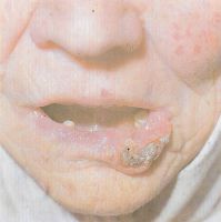  У этой больной язвенно-инфильтративная форма рака нижней трети губы расположена в боковой трети губы