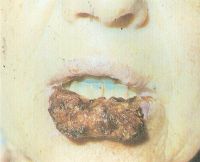 Этот больной уже на последней Т4 стадии развития папиллярного рака губы