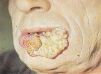 Язвенно-инфильтративная форма рака нижней губы Т4.