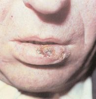 Язвенная форма рака нижней губы расположена в средней трети, Т3 стадия
