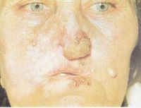 У этой больной также туберкулёзная волчанка сопровождающаяся раком нижней губы, кончика и крыльев носа