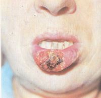 Рак губы прогрессирует: стадия Т2