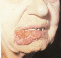 Обширная опухоль нижней губы, распространившаяся на кожу подбородка — Т4