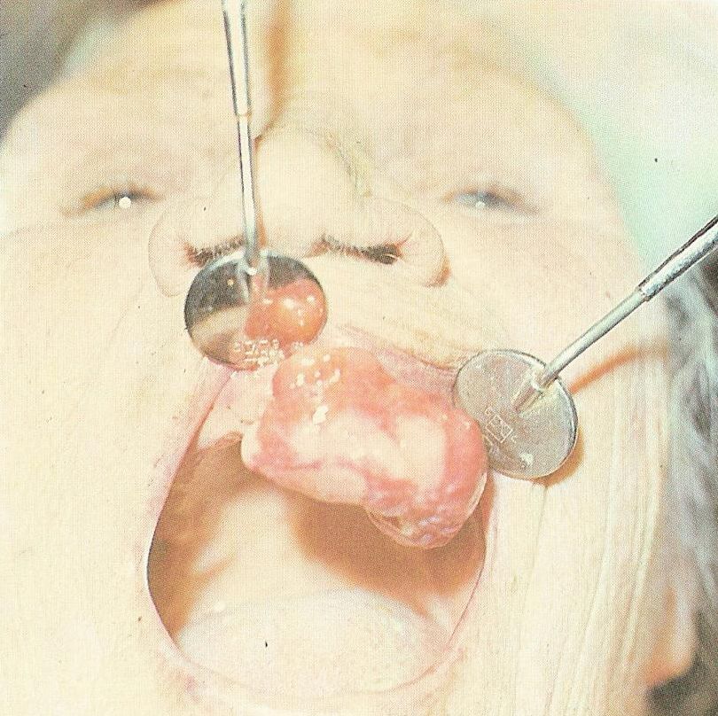 злокачественная опухоль альвеолярного отростка верхней челюсти
