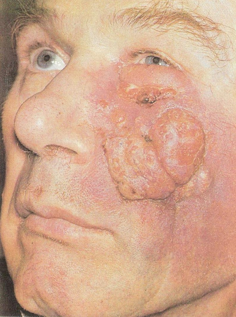 рак кожи лица