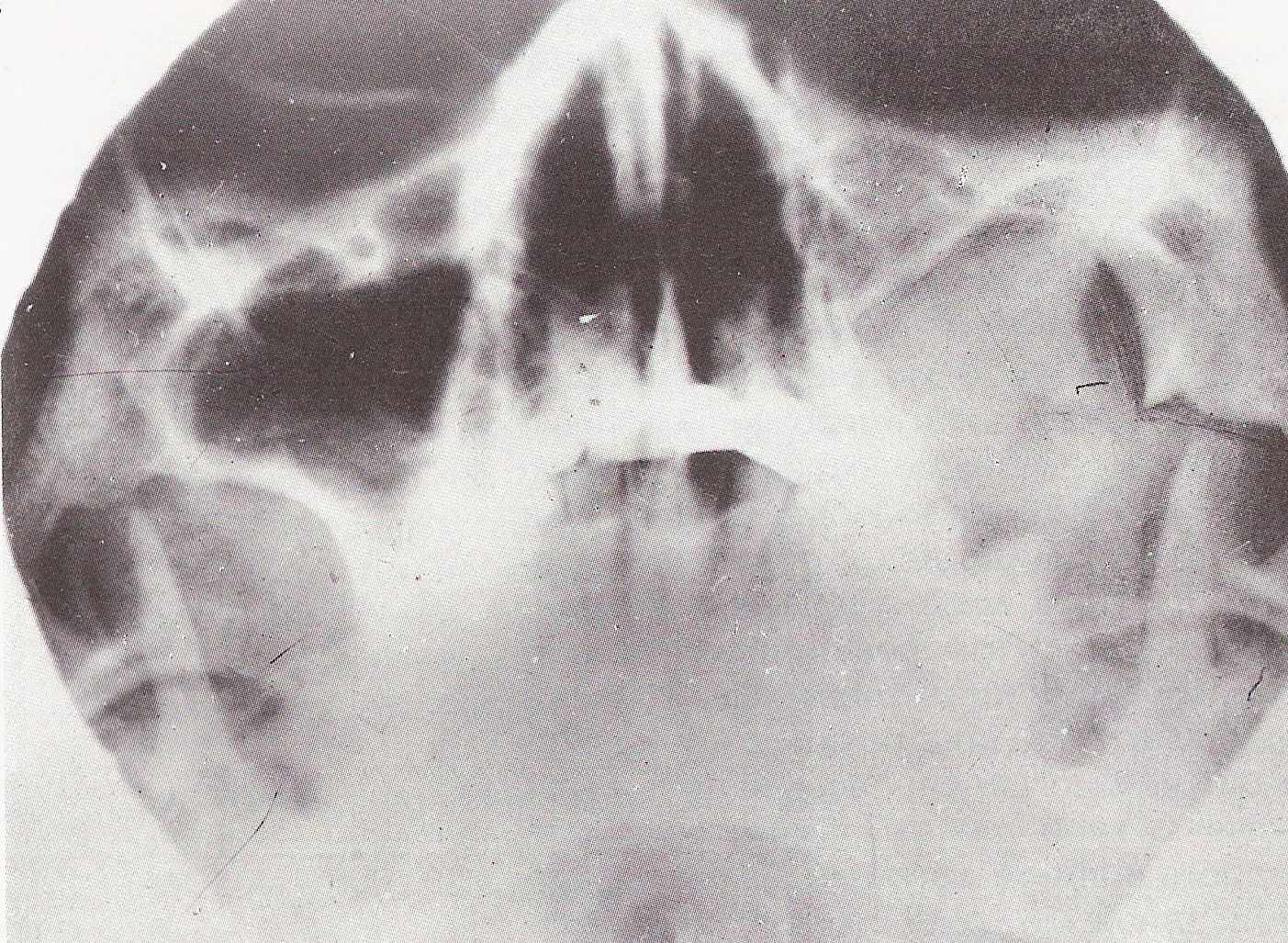 рентгенография рака верхней челюсти
