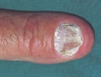 Дистрофия ногтевой пластинки большого пальца с некоторым подногтевым гиперкератозом