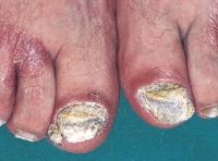 Подногтевой гиперкератоз и дистрофия ногтевой пластинки