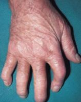 Псориатический артрит руки с поражением как проксимальных так и дистальных межфаланговых суставов. Последнее характерно для псориатической артропатии