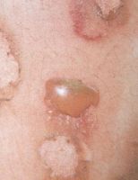 Пузыри возникшие в связи с попаданием дитранола на кожу без псориатических бляшек