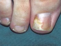 Онихолизис ногтя большого пальца ноги при псориазе