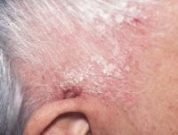 Выпадение волос при псориазе кожи в области скальпа