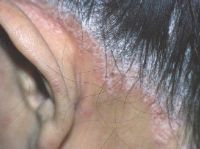 Распространённое место псориаза кожи головы - позади уха