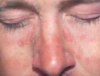 Псориаз на лице в типичных местах себорейной экземы
