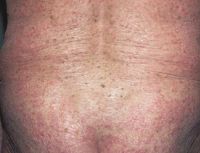 Многочисленные лентиго (веснушки) из-за долгосрочной ПУВА-терапии(использование фотоактивного вещества с облучением кожи) при тяжелой форме псориаза.