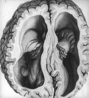 водянка головного мозга у больного олигофренией
