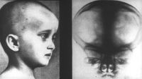 Ребенок с микроцефалией. Рентгеновский снимок черепа