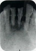 Зубной камень и потеря части кости