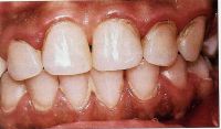 Зубной камень на язычной поверхности зубов