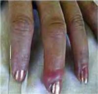 припухлость и  боль среднего пальца