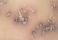 на фото микропрепарат - четко видно возбудителя столбняка Clostridium tetani